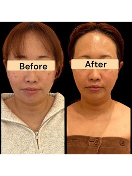 ワイズ 沖縄うるま院(Medical Y's)/糸リフトにも負けなボトサリフト