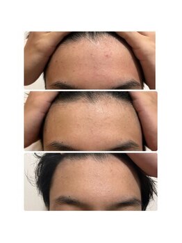 ティアレ 廿日市店(Tiare)/ヤクジョ水　ニキビケア