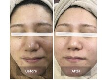 モカ 天王寺店(MOKA)/剥離ハーブピーリングニキビケア