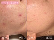 テン(10ten)/ニキビ・赤み軽減