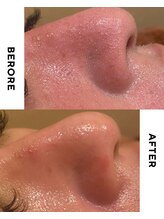 クプラニ 美浜店(kupulani)/ハイドロフェイシャル（毛穴洗浄