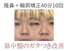 ラプリ 梅田店(Raplit)/隆鼻＋輪郭矯正40分10回