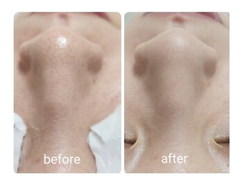 キレイラボ(Ki-Re-i LABO)/毛穴洗浄ハイドラ