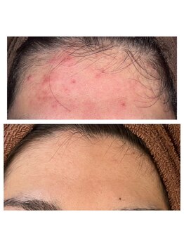 プルメリア(Plumeria)/スヴェイルスキンニキビ効果5