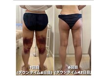 シズク(sizucu)/ダウンタイムケア