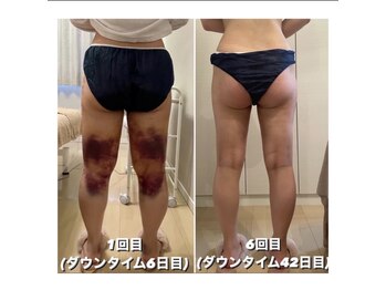 シズク(sizucu)/ダウンタイムケア