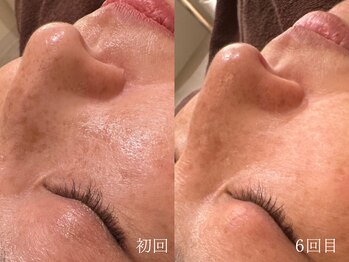 ウォーム(warm)/シミケア/美白/脱ピーリング