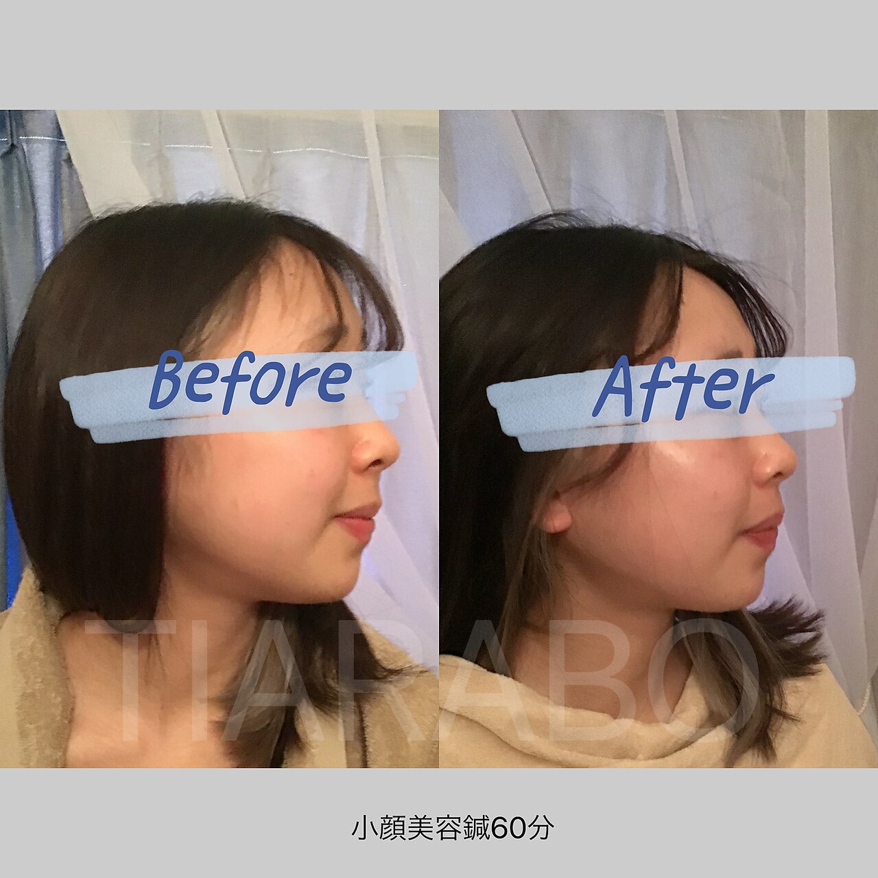 【一番人気♪】小顔電気鍼×立体小顔リフト☆小顔美容鍼60分