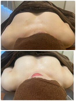 リリー(Lily)/ビフォーアフター