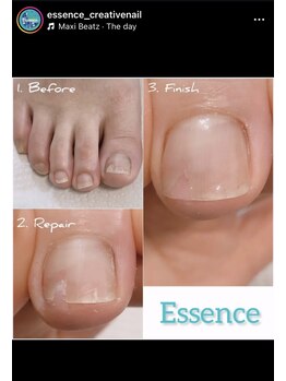 エッセンス (Essence)/親指の割れ爪 - 補強リペア