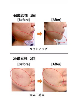 ソワンドボーテ クー(Soin de Beaut'e Quu)/フェイシャル/ビフォーアフター