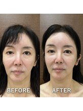 インディバサロン ド メイリィチィフゥア(indibasalon de meiliqihua)/頭皮ケア15分で驚きの効果