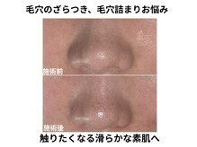 ルーモアンド(Lumo&)の雰囲気（毛穴の開き/たるみ毛穴/皮脂詰まり/黒ずみ/ニキビの気になる方に）