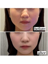 シェアサロン レノール(SHARE SALON LENORL)/【テラボーラー】小顔ケア