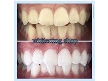 ホワイトニングショップ 柏店/人気No.1☆ホワイトニング