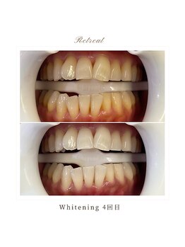 リトリート(Retreat)/ホワイトニング【4回ご来店】