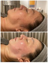 ヒュッゲサロン(HYGGE Salon)/ハーブ2.0ｇ　1回の施術効果