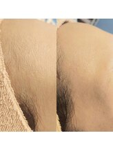 キアラ 麻布十番(Kiara)/顔ワックス脱毛のビフォーアフタ