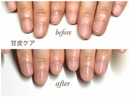 甘皮ケア