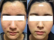 エピア 西尾店(Epia)/全顔ニキビ/10代女性