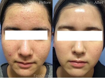 エピア 西尾店(Epia)/全顔ニキビ/10代女性