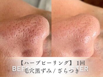 ベルペール(Belle perle)/【ハーブピーリング】毛穴/シミ