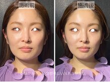 ラバ 名古屋栄店(LAVA)/小顔コルギ【エラ張り】