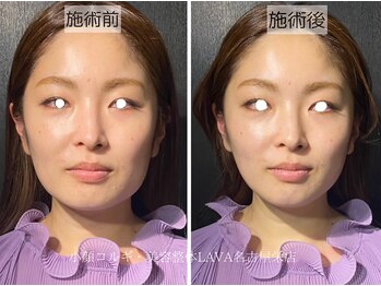 ラバ 名古屋栄店(LAVA)/小顔コルギ【エラ張り】