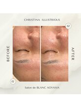 サロン ド ブラン アオヤマ(Salon de BLANC AOYAMA)/イラストリアス×ソノケア