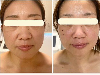 エヴァル 久留米店(ewalu)/温熱小顔リフト