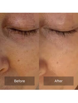 テセラ(TETHERA)/ナノテクノロジーフェイシャル