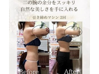 ラフィール/二の腕の引き締め２回 一目瞭然