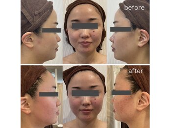 プロラボスパ 姫路店/20代後半 症例写真