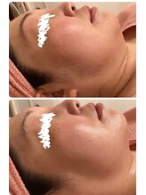 ロゼブランシュ(Rose Blanche)/あご下のお肉がスッキリ！