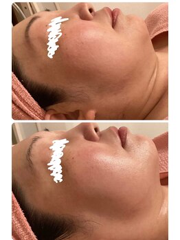 ロゼブランシュ(Rose Blanche)/あご下のお肉がスッキリ!