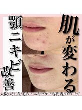 アルムダアクア 天王寺店(Aleumda AQUA)/大阪/天王寺/ハーブピーリング