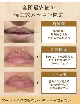 ミニマル(minimal)の写真/唇やバストトップのお色味やくすみでお悩みの方へ。まずは無料相談で不安を解消しましょう◎