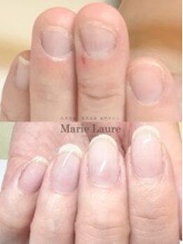 マリーロール 梅田店(Marie Laure)/自爪育成/深爪矯正/ネイルケア