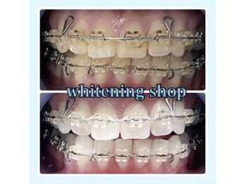 ホワイトニングショップ 柏店/矯正中でもホワイトニング◎