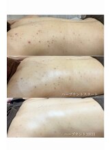 イチロクイチハチ(1618)/#ニキビケア#ホルモンバランス