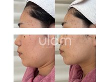 負担なく効率的に弾力とリフトアップ！白玉酸素管理と同時施術