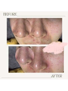 サロン ド ミコラ(salon de Micora)/次世代美容液毛穴洗浄