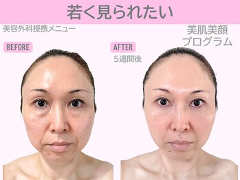 ぷるるんエステ/フェイシャル/小顔/毛穴