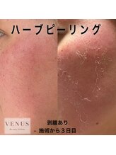 ヴィーナス 浦安店(VENUS)/イロン　ハーブピーリング