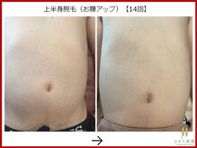 ひかり素肌/上半身脱毛14回