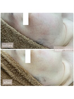 サロンディト(ditto)/【施術6回】小顔コルギ+顔脱毛