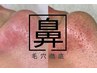 最上級ケア！脱イチゴ鼻　徹底キレイスペシャルコース　海藻アルゲパック付き