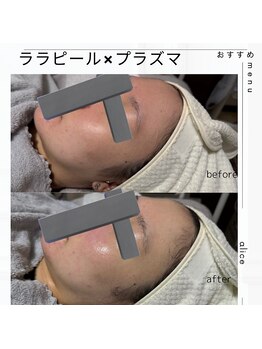 アリス(Alice)/ララピール×プラズマ