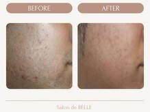 サロンドベル(Salon de BELLE)/ビフォー&アフター(メンズ髭)