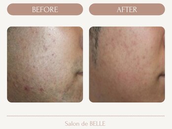 サロンドベル(Salon de BELLE)/ビフォー&アフター(メンズ髭)